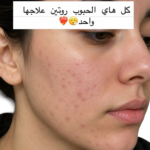 PanOxyl Acne Foaming Wash 10% Benzoyl Peroxide 156g – Nettoyant Anti Acn Maximum Strength – Image 2
